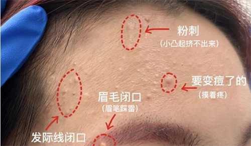 臉上經(jīng)常長(zhǎng)閉口粉刺的原因有哪些？