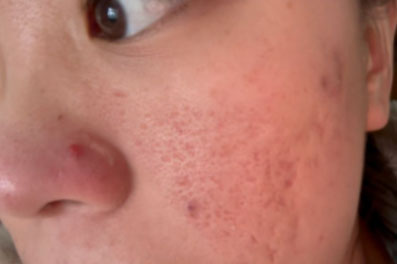 去痘印做什么醫(yī)美項(xiàng)目最好？