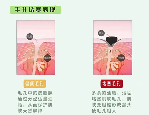 毛孔堵塞怎么疏通毛孔？