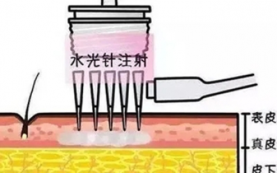 水光針的類型有哪幾種？